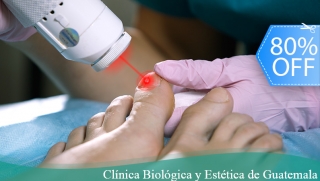 Sesión Láser para Hongos en 10 Uñas + Pedicure o Manicure Clínico.