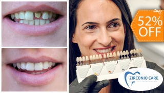 [Image: Carilla Dental de Cerómero + Limpieza con Ultrasonidom]