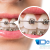 [Imagen:¡Paga Q365 en lugar de Q2,500 por Colocación de Brackets (Superiores e Inferiores) + Limpieza Dental + Consulta Diagnóstica + Fotografías!]