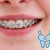 [Image: ¡Paga Q590 en lugar de Q3,000 por Colocación de Brackets Metálicos (Superiores e Inferiores) + Evaluación y Diagnóstico Clínico + Profilaxis Dental + Fotografías + Blanqueamiento Dental!m]