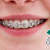 [Image: ¡Paga Q599 en lugar de Q1,800 por Colocación de Mini-Brackets (Superiores e Inferiores) + Evaluación y Diagnóstico Clínico + Profilaxis Dental + Fotografías y Modelo de Estudio!m]