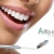 [Imagen:¡Paga $60 en Lugar de $215 por 2 Aplicaciones de Blanqueamiento Dental con Luz LED en 1 Sola Sesión + Limpieza Dental!]