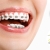 [Image: ¡Paga $49 en Lugar de $420 por Colocación de Brackets Metálicos + Evaluación y Diagnóstico Clínico + Fotografías y Modelo de Estudio + 1 Consulta de Control + 1 Limpieza Dental!m]