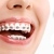 [Image: ¡Paga Q299 en Lugar de Q1,800 por Colocación de Brackets Metálicos (Superiores e Inferiores) + Evaluación y Diagnóstico Clínico + Profilaxis Dental + Fotografías Dentales!m]