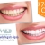 [Image: ¡Paga $85 en vez de $325 por 1 Sesión de Blanqueamiento Dental con Sistema Zoom + Consulta Odontológica + Diagnóstico con Cámara Intraoral + Limpieza con Ultrasonido en la lujosa sala VIP de Western Dental San Benito!m]
