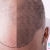 [Image: ¡Libérate YA de la Calvicie! ¡Paga Q699 en vez de Q3,125 por Paquete para Alopecia que incluye: 1 Sesión de Plasma Rico en Plaquetas + 2 Sesiones de Carboxiterapia + 1 Sesión de Luz LED roja en Clínica Dermatológica Kalyana!m]