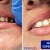 [Image: ¡Paga $250 en Lugar de $550 por Prótesis Dental Unilateral Removible (hasta 5 Dientes) + Diagnóstico y Evaluación con Cámara Intraoral + Limpieza con Ultrasonido + Pulido Dental + Aplicación de Flúor + 2 Sellantes + Evaluación de Cordales!m]