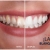 [Image: ¡Paga Q130 en Lugar de Q285 por 3 Lápices Blanqueadores de Dientes!m]