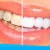 [Image: ¡Paga $79 en vez de $325 por 1 Sesión de Blanqueamiento Dental EXTREMO con sistema ZOOM + Limpieza con Ultrasonido!m]