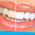 [Imagen:¡Paga $75 en vez de $325 por 1 Sesión de Blanqueamiento Dental EXTREMO con sistema ZOOM + Limpieza con Ultrasonido!]