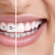 [Imagen:¡Paga $95 en Lugar de $575 por Colocación de Brackets Metálicos para Alineación de los Dientes!]