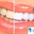[Imagen:¡Paga Q395 en vez de Q1,500 por Blanqueamiento con Luz LED + Limpieza y Pulido Dental con Profilaxis + Eliminación de Sarro con Ultrasonido + Aplicación Tópica de Flúor + Examen Diagnóstico!]
