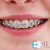 [Imagen:¡Paga $75 en Lugar de $225 por Colocación de Mini-Brackets Metálicos + Evaluación y Diagnóstico Clínico + Fotografía y Modelos de Estudio!]