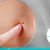 [Imagen:¡Paga $20 en Lugar de $100 por Eliminación de hasta 20 Verrugas o Cabezas de Vena en Cuello, Axilas o Rostro + Consulta Dermatológica!]