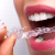 [Imagen:¡Paga $18 en Lugar de $125 por Férula Dental + Evaluación Dental + Limpieza con Ultrasonido + Aplicación Tópica de Flúor!]