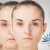 [Imagen:¡Paga $199 en Lugar de $450 por 3 Sesiones de Rejuvenecimiento Facial con: 3 Plasmas Ricos en Plaquetas + 3 Microdermoabrasiones + 3 Extracciones de Puntos + 3 Limpiezas Faciales + Consulta Médica!]