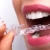 [Imagen:¡Paga $15 en Lugar de $125 por Férula Dental + Evaluación Dental + Limpieza con Ultrasonido + Aplicación Tópica de Flúor!]
