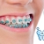 [Imagen:¡Paga Q499 en lugar de Q3,000 por Colocación de Mini-Brackets Metálicos (Superiores e Inferiores) + Evaluación y Diagnóstico Clínico + Profilaxis Dental + Fotografías + Kit de Limpieza Completo!]