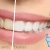 [Imagen:¡Paga Q395 en lugar de Q1,800 por Blanqueamiento Dental Láser + Pulido Dental con Profijet + Limpieza con Ultrasonido + Aplicación de Flúor y Evaluación con Cámara Intraoral!]