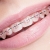 [Imagen:¡Paga Q1,400 en lugar de Q4,500 por Colocación de Mini-Brackets INVISIBLES (Superiores e Inferiores) + Evaluación y Diagnóstico Clínico + Profilaxis Dental + Fotografías y Modelo de Estudio!]