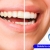 [Imagen:¡Paga $50 en Lugar de $250 por Blanqueamiento Dental Químico con Luz LED + Baño de Gel Desensibilizante + Limpieza Profunda con Ultrasonido (Destartraje) + Consulta Odontológica!]