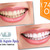 [Imagen:¡Paga $85 en vez de $325 por 1 Sesión de Blanqueamiento Dental con Sistema Zoom + Consulta Odontológica + Diagnóstico con Cámara Intraoral + Limpieza con Ultrasonido en la lujosa sala VIP de Western Dental San Benito!]