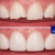 [Imagen:¡Paga $40 en Lugar de $230 por Reconstrucción Estética Mínimamente Invasiva con Resina de 4 Dientes Frontales + Consulta General + Revisión de Cordales + Limpieza Dental + Aplicación Tópica de Flúor!]