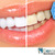 [Imagen:¡Paga Q395 en lugar de Q1,500 por Blanqueamiento Dental Láser + Limpieza y Pulido Dental con Profilaxis + Eliminación de Sarro con Ultrasonido + Aplicación Tópica de Flúor + Examen Diagnóstico en Dental Life!]