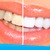 [Imagen:¡Paga $79 en vez de $325 por 1 Sesión de Blanqueamiento Dental EXTREMO con sistema ZOOM + Limpieza con Ultrasonido!]