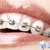 [Imagen:¡Paga $85 en lugar de $450 por Colocación de Mini-Brackets Metálicos + Evaluación y Diagnóstico de Ortodoncia + Diagnóstico Odontológico General + Profilaxis Dental!]