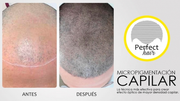 [Image: ¡Paga $150 en Lugar de $300 por 2 Sesiones de Micropigmentación Capilar!m]