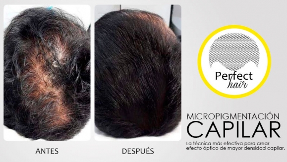 [Image: ¡Paga $150 en Lugar de $300 por 2 Sesiones de Micropigmentación Capilar!m]
