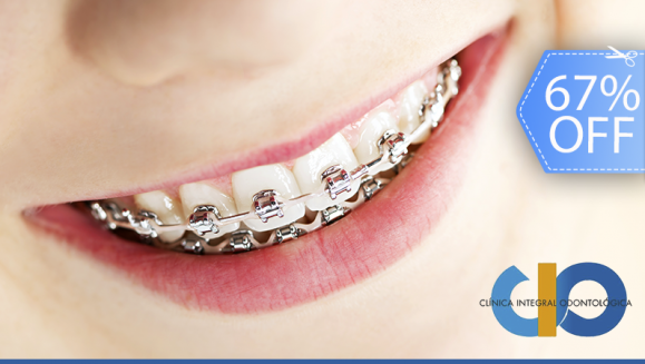 [Image: ¡Paga Q599 en Lugar de Q1,800 por Paquete de Ortodoncia que Incluye: Colocación de Brackets Metálicos (Superiores e Inferiores) + Evaluación y Diagnóstico Clínico + Limpieza Completa + Fotografías y Modelo de Estudio!m]