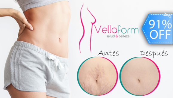 [Image: ¡Paga Q399 en vez de Q4,220 por 22 Tratamientos para Disminuir Estrías: 4 Mesoterapias Tópicas + 2 Peelings Químicos + 2 Microdermoabrasiones + 2 Radiofrecuencias Infrarrojas + 2 Mascarillas Regeneradoras Celulares + 4 Corrientes Galvánicas y Más!m]