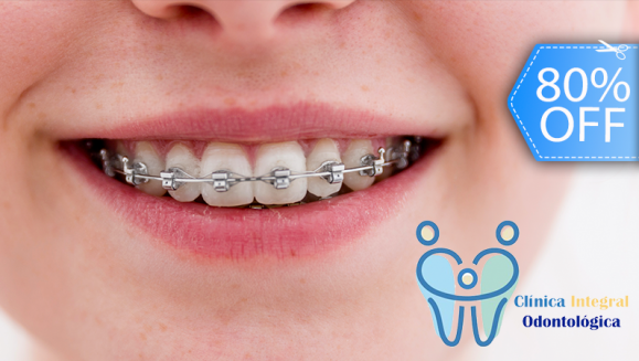 [Image: ¡Paga Q590 en lugar de Q3,000 por Colocación de Brackets Metálicos (Superiores e Inferiores) + Evaluación y Diagnóstico Clínico + Profilaxis Dental + Fotografías + Blanqueamiento Dental!m]
