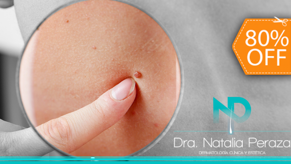 [Image: ¡Paga $20 en Lugar de $100 por Eliminación de hasta 20 Verrugas o Cabezas de Vena en Cuello, Axilas o Rostro + Consulta Dermatológica!m]