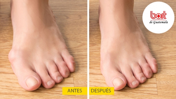 [Image: ¡Paga Q99 en lugar de Q200 por Férula Hallux Valgus para Corrección de Juanetes!m]