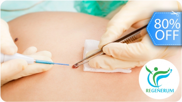 [Image: ¡Paga Q99 en lugar de Q500 por Cauterización Láser de Lunares, Verrugas, Cabezas de Vena o Mezquinos + Evaluación Médica!m]