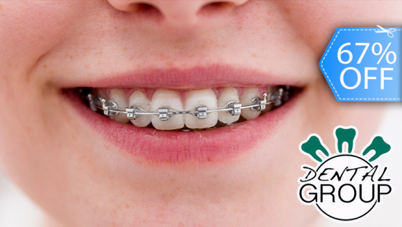 [Image: ¡Paga Q599 en lugar de Q1,800 por Colocación de Mini-Brackets (Superiores e Inferiores) + Evaluación y Diagnóstico Clínico + Profilaxis Dental + Fotografías y Modelo de Estudio!m]