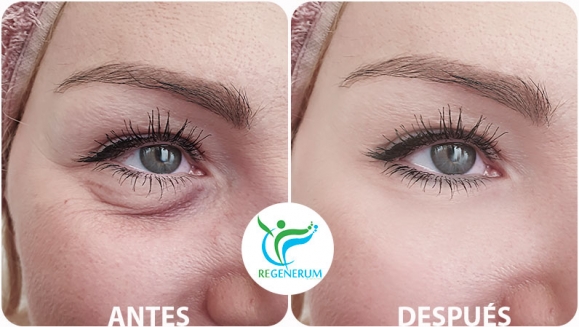 [Image: ¡Paga Q999 en lugar de Q4,500 por Lifting de Párpados (Superiores o Inferiores) o del Labio Superior (Código de Barras) con Plasma Láser!m]