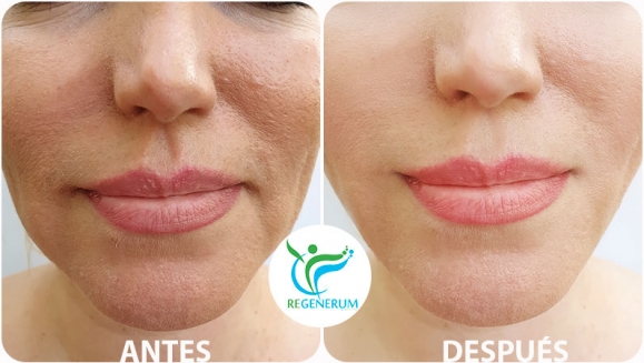 [Image: ¡Paga Q999 en lugar de Q4,500 por Lifting de Párpados (Superiores o Inferiores) o del Labio Superior (Código de Barras) con Plasma Láser!m]