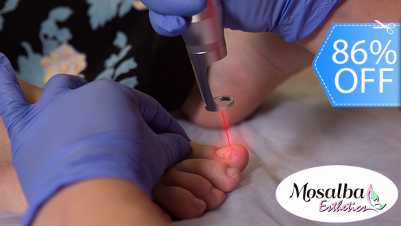 [Image: ¡Paga Q250 en Lugar de Q1,800 por 3 Sesiones Láser para Eliminar Hongos en hasta 10 Uñas de Manos o Pies + Diagnóstico Profesional + Aplicación de Crema Antimicótica!m]