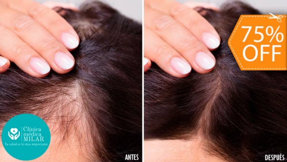[Image: ¡Paga $75 en Lugar de $300 por 3 Sesiones de Mesoterapia y Altafrecuencia Capilar para Estimular el Crecimiento del Cabello y Evitar La Calvicie!m]
