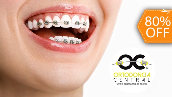 [Image: ¡Paga $90 en Lugar de $450 por Colocación de Brackets Metálicos + Evaluación y Diagnóstico Clínico + Fotografías y Modelo de Estudio + 3 Consultas de Control!m]