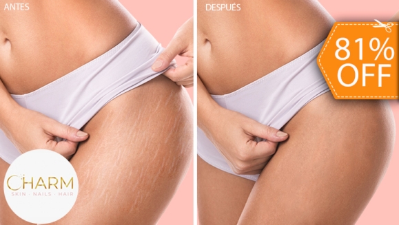 [Image: ¡Paga $28 en Lugar de $150 por 1 Sesión para Reducción de Estrías con 1 Plasma Rico en Plaquetas o Extracto de Colágeno con Dermógrafo + 1 Microdermoabrasión + 1 Altafrecuencia + 1 Mascarilla de Colágeno + 1 Mascarilla Hidratante y Más!m]