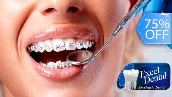 [Image: ¡Paga Q549 en Lugar de Q2,200 por Colocación de Brackets Metálicos Superiores e Inferiores + Evaluación y Diagnóstico + Limpieza Dental + Fotografías y Modelo de Estudio!m]