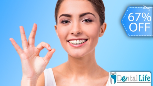 [Image: ¡Paga Q599 en Lugar de Q1,800 por Colocación de Brackets Metálicos (Superiores e Inferiores) + Evaluación y Diagnóstico Clínico + Profilaxis Dental + Fotografías Dentales!m]