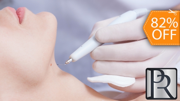 [Image: ¡Paga $18 en Lugar de $100 por Electrocauterización de Hasta 20 Verrugas!m]