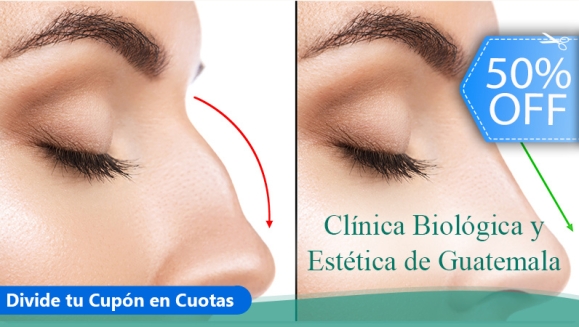 [Image: ¡Paga Q999 en Lugar de Q2,000 por Rinomodelación con Ácido Hialurónico: Perfila, Modela y Respinga la Punta de La Nariz Sin Cirugía!m]