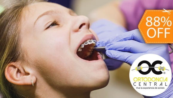 [Image: ¡Paga $49 en Lugar de $420 por Colocación de Brackets Metálicos + Evaluación y Diagnóstico Clínico + Fotografías y Modelo de Estudio + 1 Consulta de Control + 1 Limpieza Dental!m]